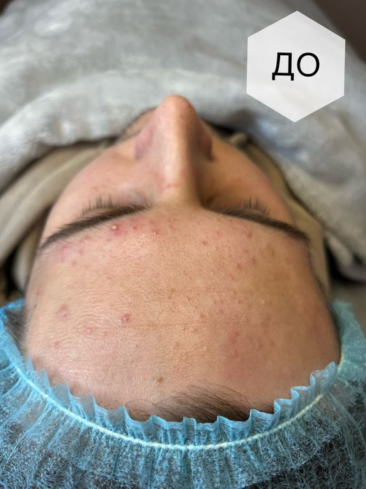 Косметолог/Ботокс Акция 1700 две зоны/Левый берег/