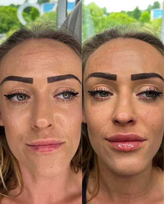 Super Promocja 450zł Modelowanie powiększanie ust wyrównanie asymetrii