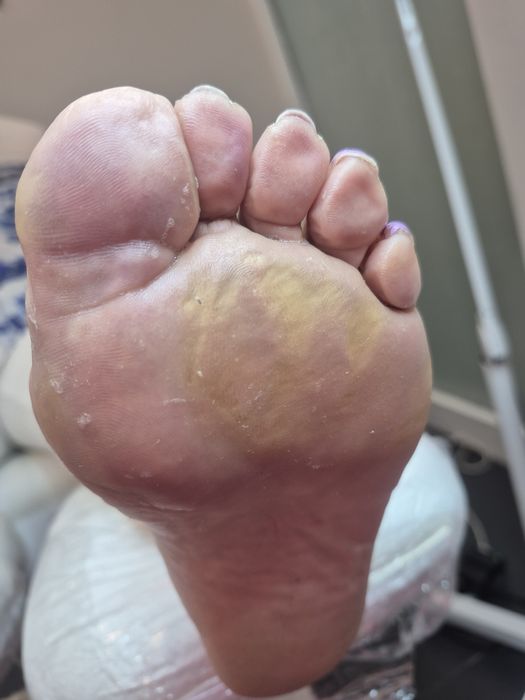 Pedicure leczniczy