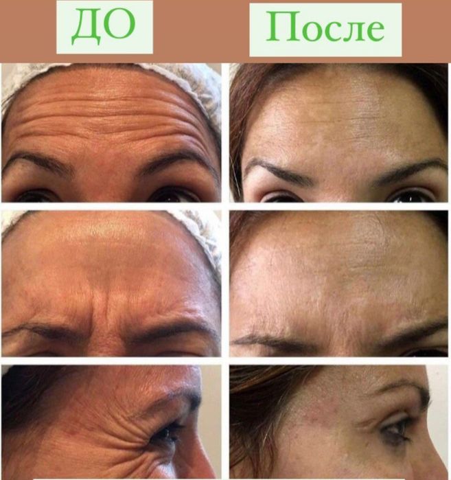 Ботокс. Коррекция морщин,всё зоны, Фулфейс.