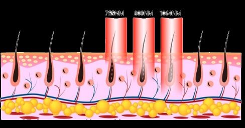 Máquina Depilação a laser 3 ondas última geração