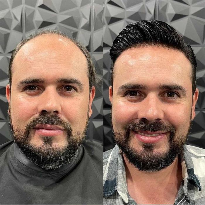 Prótese capilar em Alverca