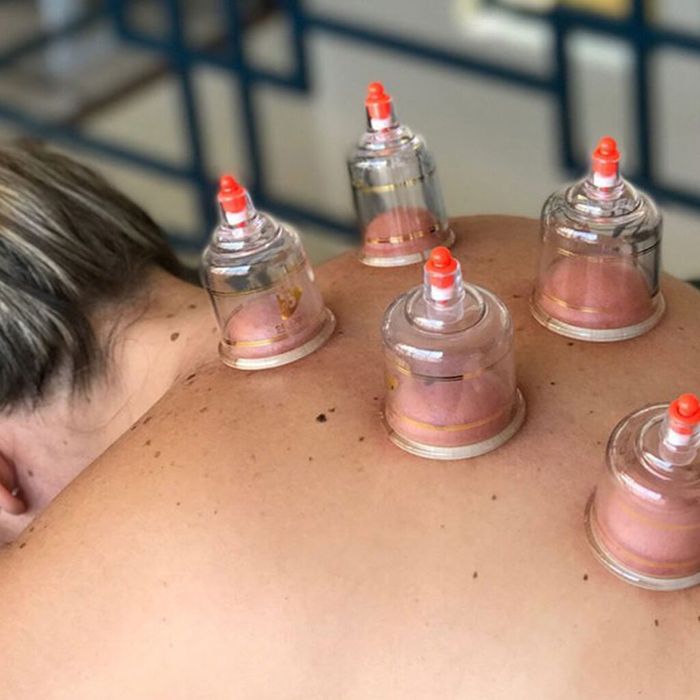 Tratamento de ventosa terapia