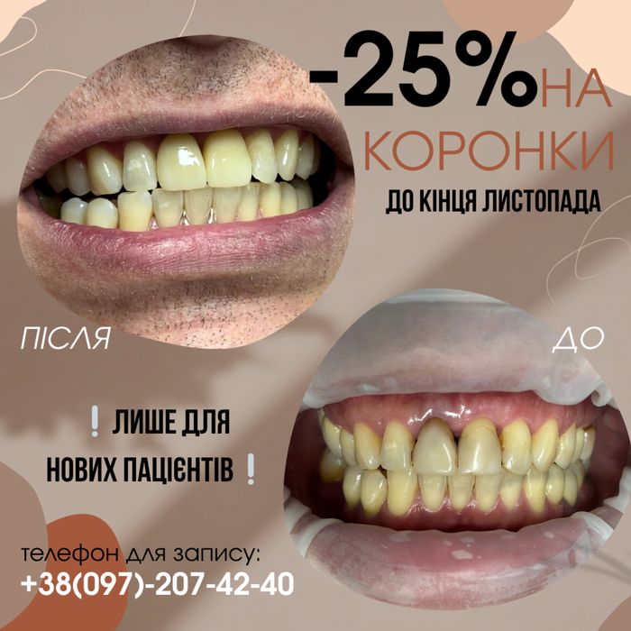 -25% на коронки. Протезування зубів до кінця листопада.