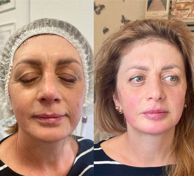 Косметолог Николаев ,губы 3500,ботокс биоревитализация