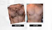 Depilação masculina a cera , máquina de aparar e laser