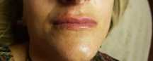 Preenchimento ácido hialuronico rugas, peelings químicos mesoterapia