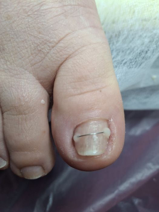 Медичний педикюр