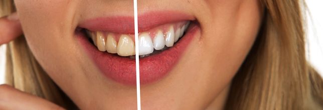 Отбеливание реставрация зубов лечение удаление протезирование