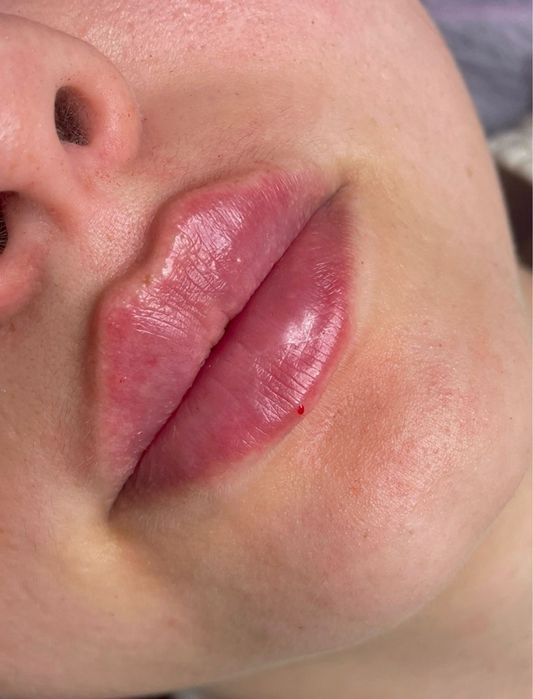 Знижка 40% Збільшення губ м. Майдан Київ увеличение косметолог центр