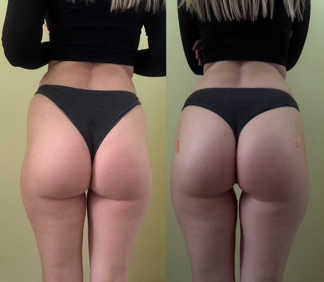 Botox/fullFace/контурная пластика/ губы