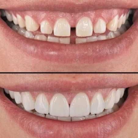 Вініри Perfect Smile Veneers Знімні накладки зубів Виниры