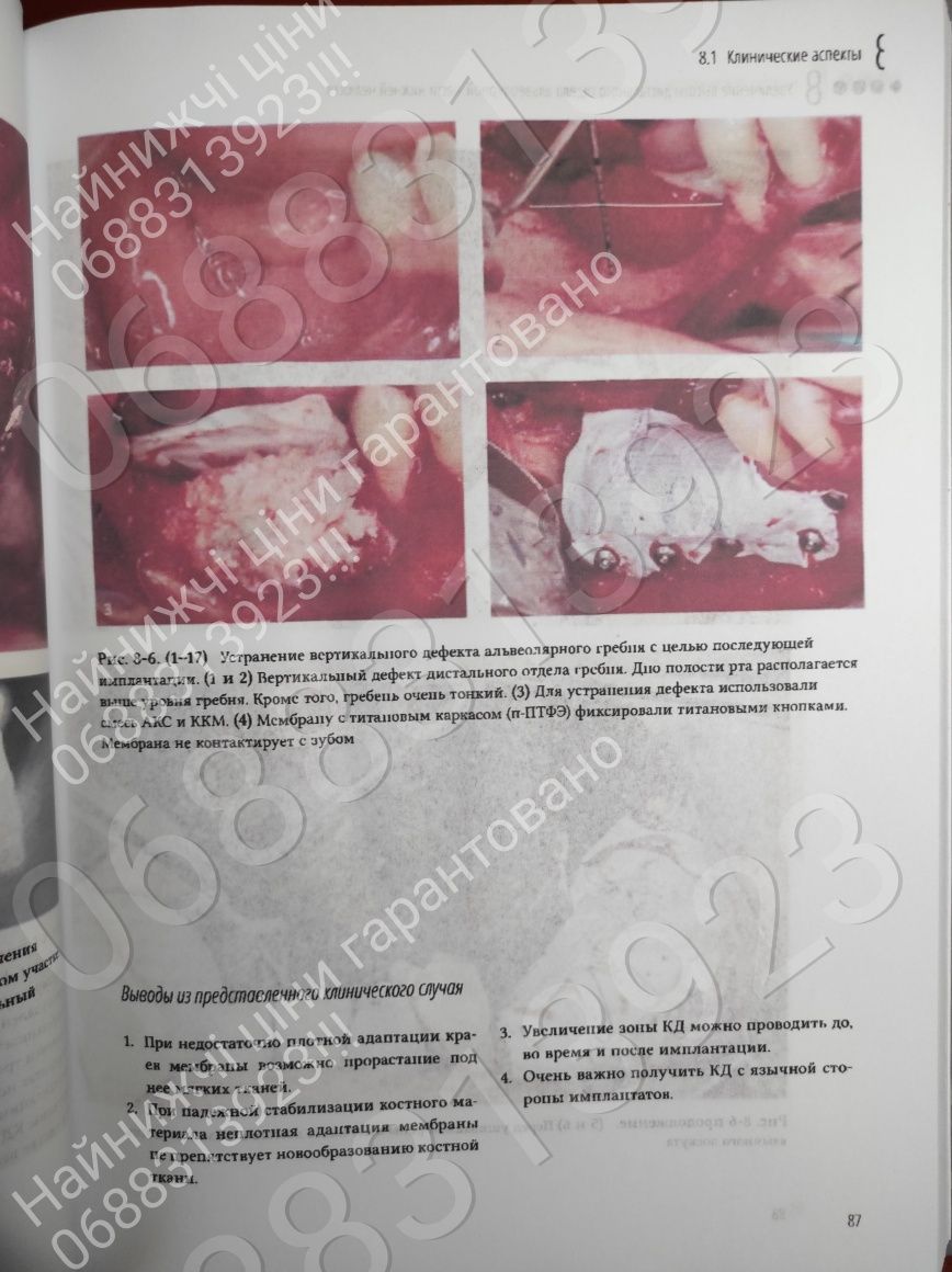 ДЕШЕВО!!! Увеличение висоти и толщини альвеолярного гребня,Иштван Урб.