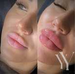 Увеличение губ от 2300 грн Sardenya Deep 1 ml