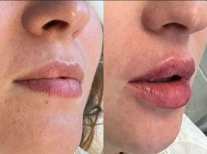 -10/procent na wszystkie zabiegi. Botox ,powiększanie ust .