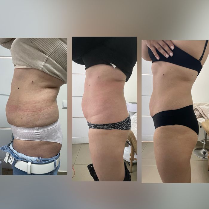 Кріоліполіз, кавітація, обгортання, ролик