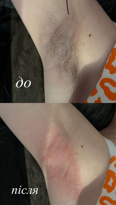 Шугаринг, сахарная депиляция 5 Заречный