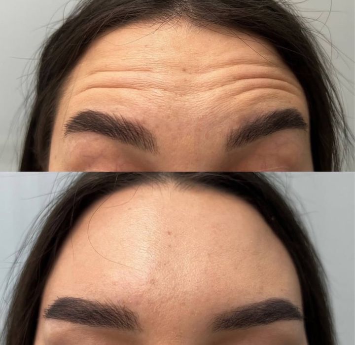 Акція на всю контурну пластику обличчя. Збільшення губ, ботокс, біо