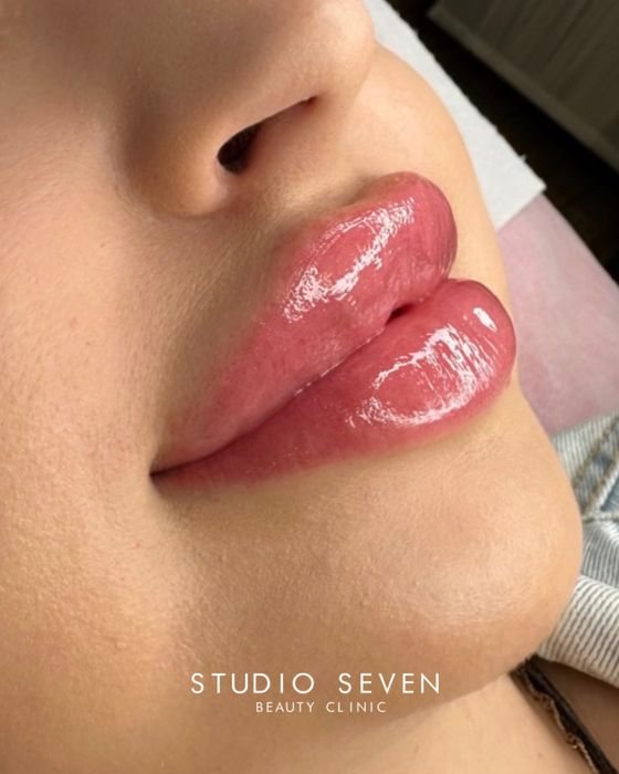 Powiekszanie ust, powiększanie, modelowanie ust