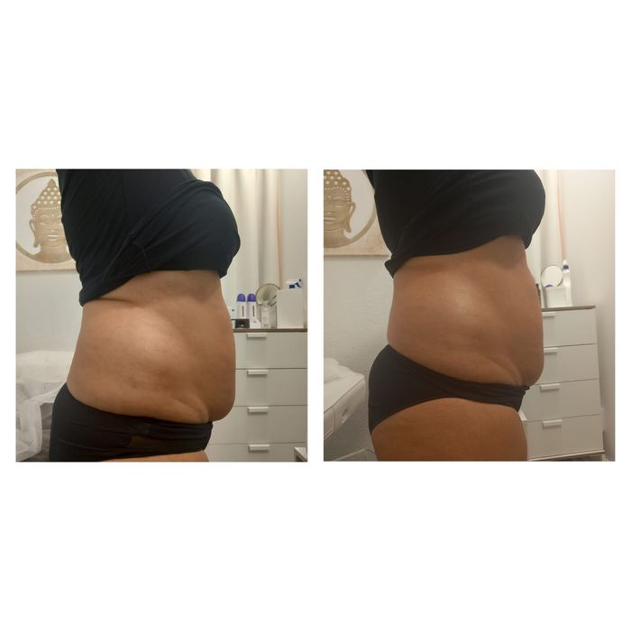 Hifu 22 rosto completo com pescoço e papada