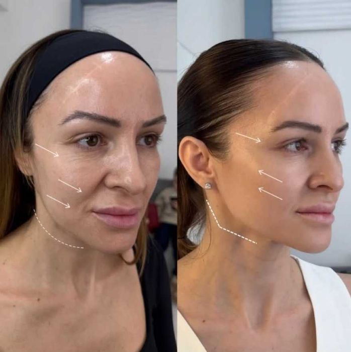 Usta 1ml od 300zł wypełniacz Premium, stymulatory, btx