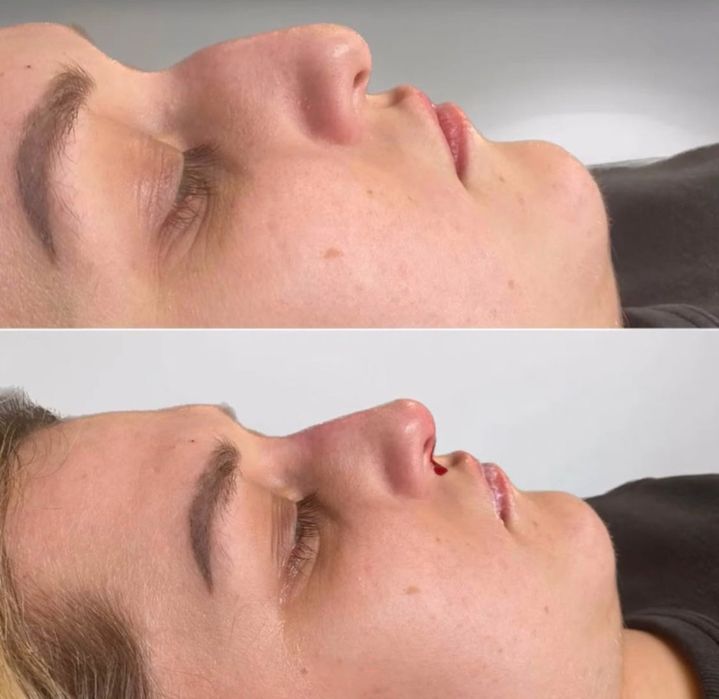 Ботокс, мезонити, увеличение губ,ягодиц