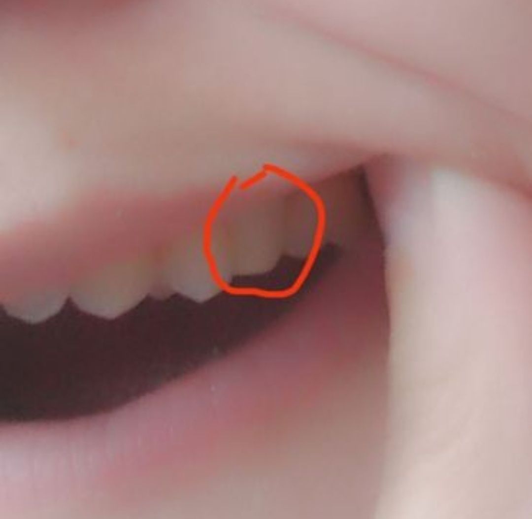 Resina Dentária! Dentaduras, Dentes em Falta e Espaços Entre os Dentes