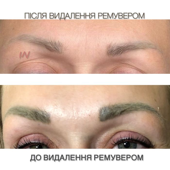 Безпечне видалення тату/татуажу, корекція шрамів