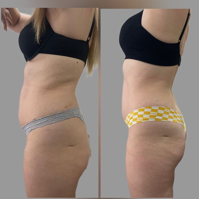 Кріоліполіз, кавітація, обгортання, ролик