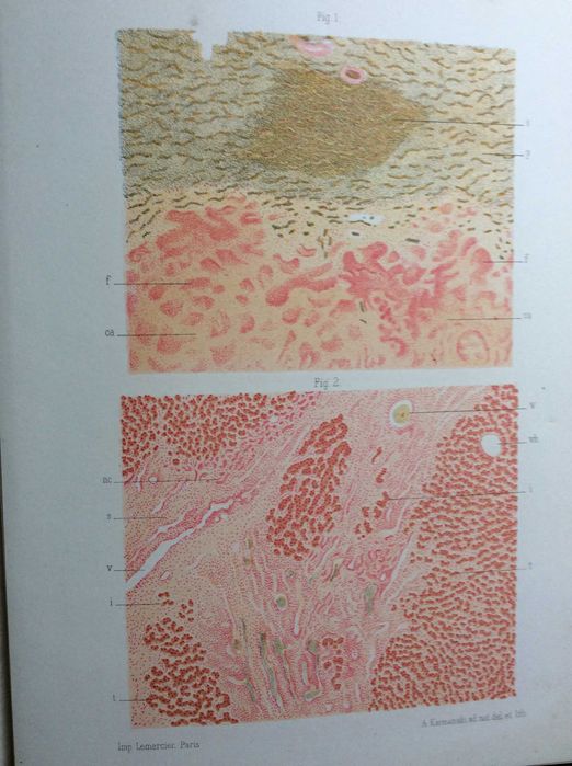 L'Inflammation. Études anatomo-pathologiques, 1893