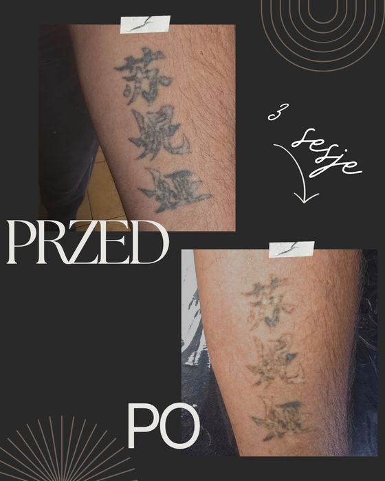 Laserowe Usuwanie Tatuażu i Makijażu Permanentnego - Studio Knurów