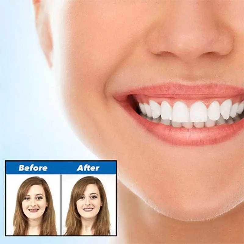 Знімні вініри для зубів Perfect Smile Veneers Голлівудська посмішка