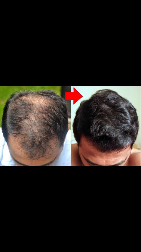 Minoxidi kirkland! Crescimento barba e cabelo