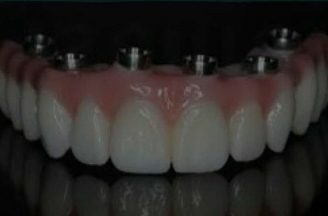 Prótese dentária confecção em geral
