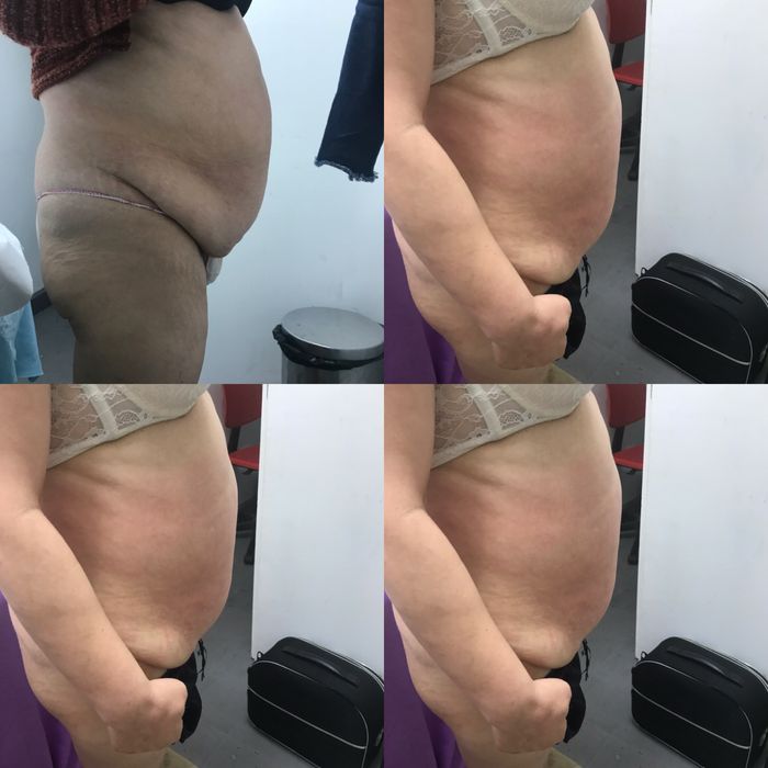 Pressoterapia drenagem linfantica mecanica