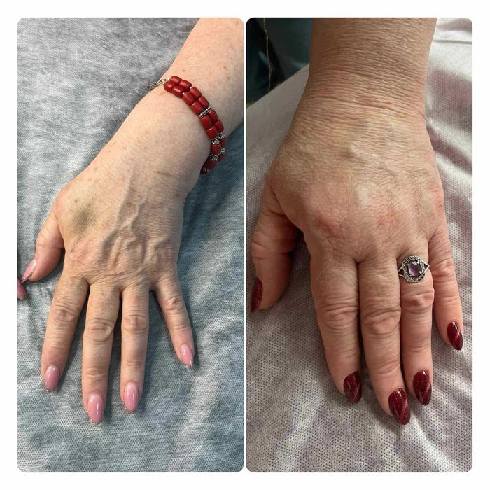 Лікар косметолог. БОТОКС . Ін'єкції краси.