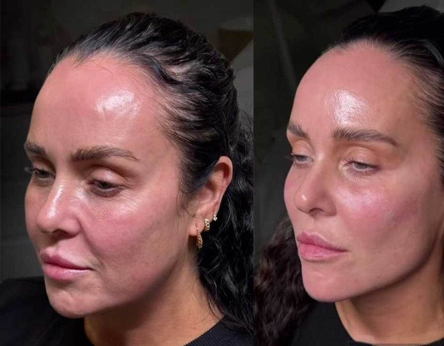 Usta 1ml od 300zł wypełniacz Premium, stymulatory, btx