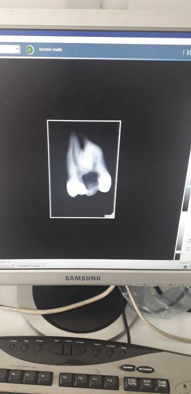 Стоматологічний ( дентальний) рентген з візіографом + компютер