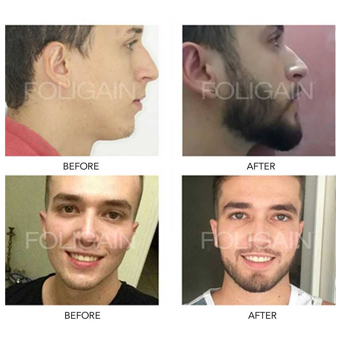 kit 3 Minoxidil tb versão baixo Álcool Entrega Grátis em Cascais