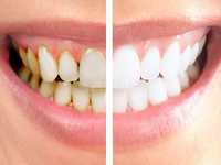 500грн!Чистка зубів: Air-flow+ ультразвук. Чистка зубов.Стоматолог
