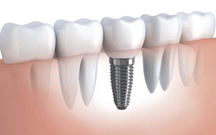 IMPLANTES DE DENTES   em várias tranches        varios pagamentos um  sorriso e expressao facial de excelência