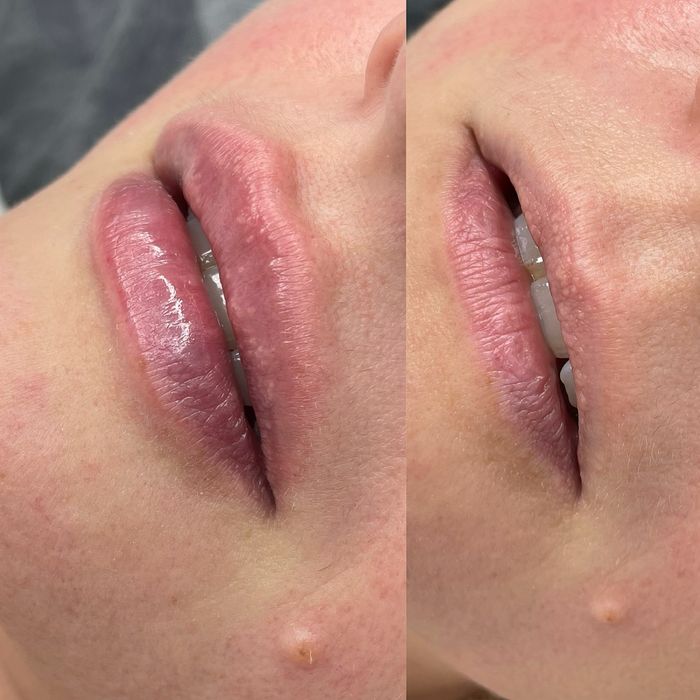 Косметолог інʼєкціоніст (губи 4000/ботокс/біоревіталізація)