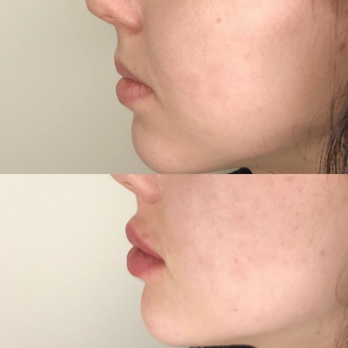 Губи та Ботокс  Новорічні знижки !!!