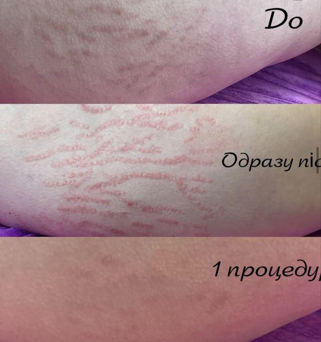 мікронідлінг з 0 до прфі курси