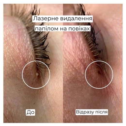 Лазерне видалення папілом