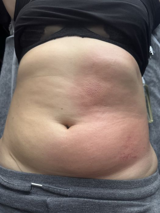 Пресотерапія, ліпопластика, лімфодренаж, кавітація  , масаж