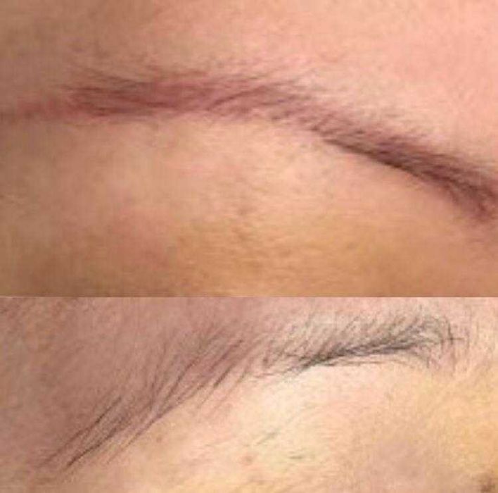 Безпечне видалення тату/татуажу, корекція шрамів