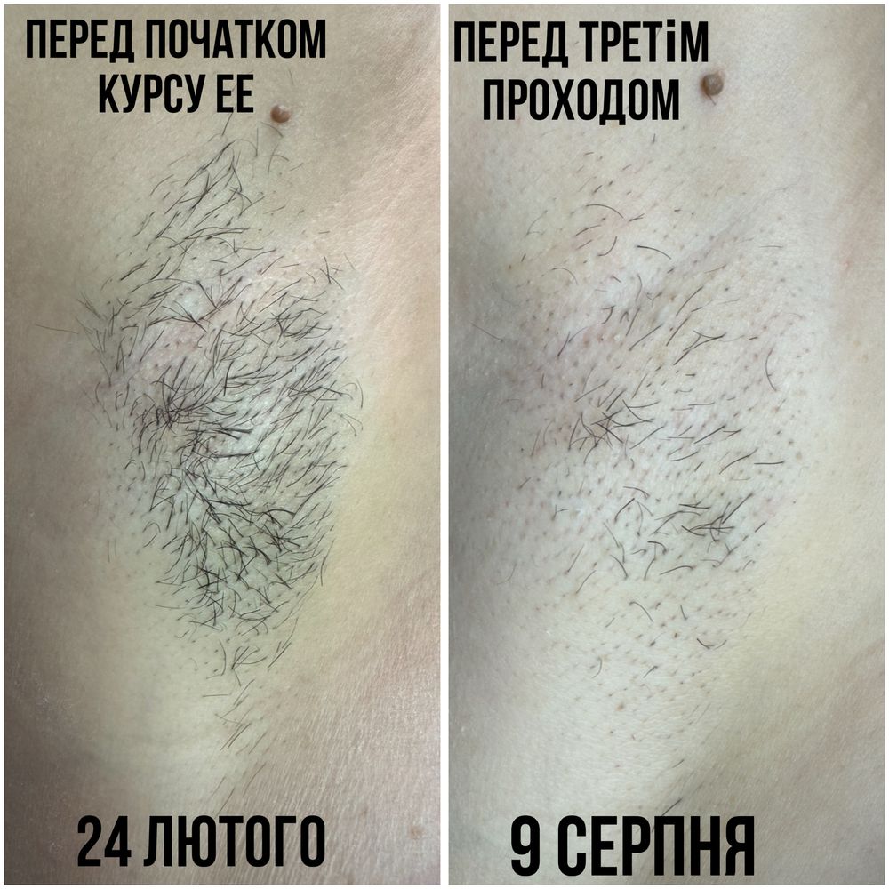 Електроепіляція, воскова депіляція, шугаринг