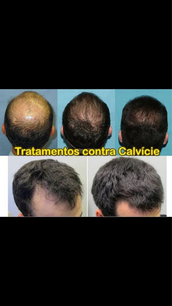 Minoxidil Foligain forte! Cabelo e barba de volta