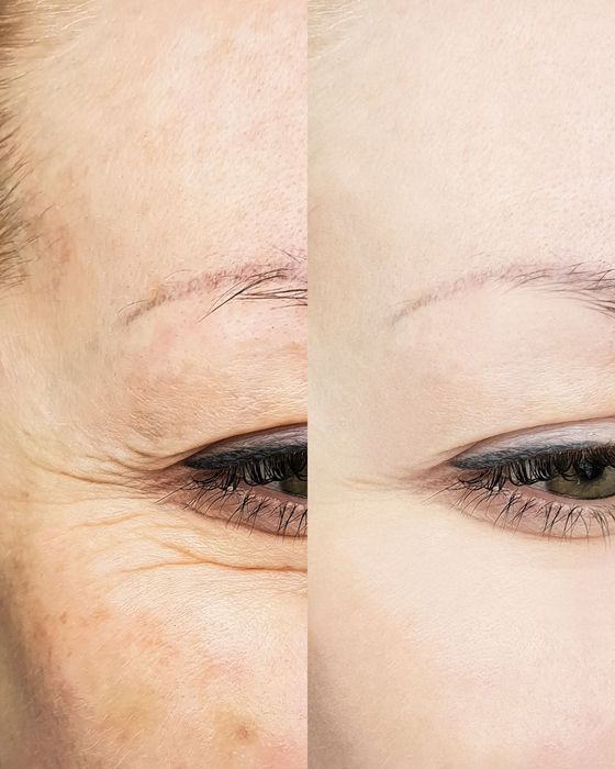 Stymulatory tkankowe pod oczy – redukcja zmarszczek i napięcie skóry